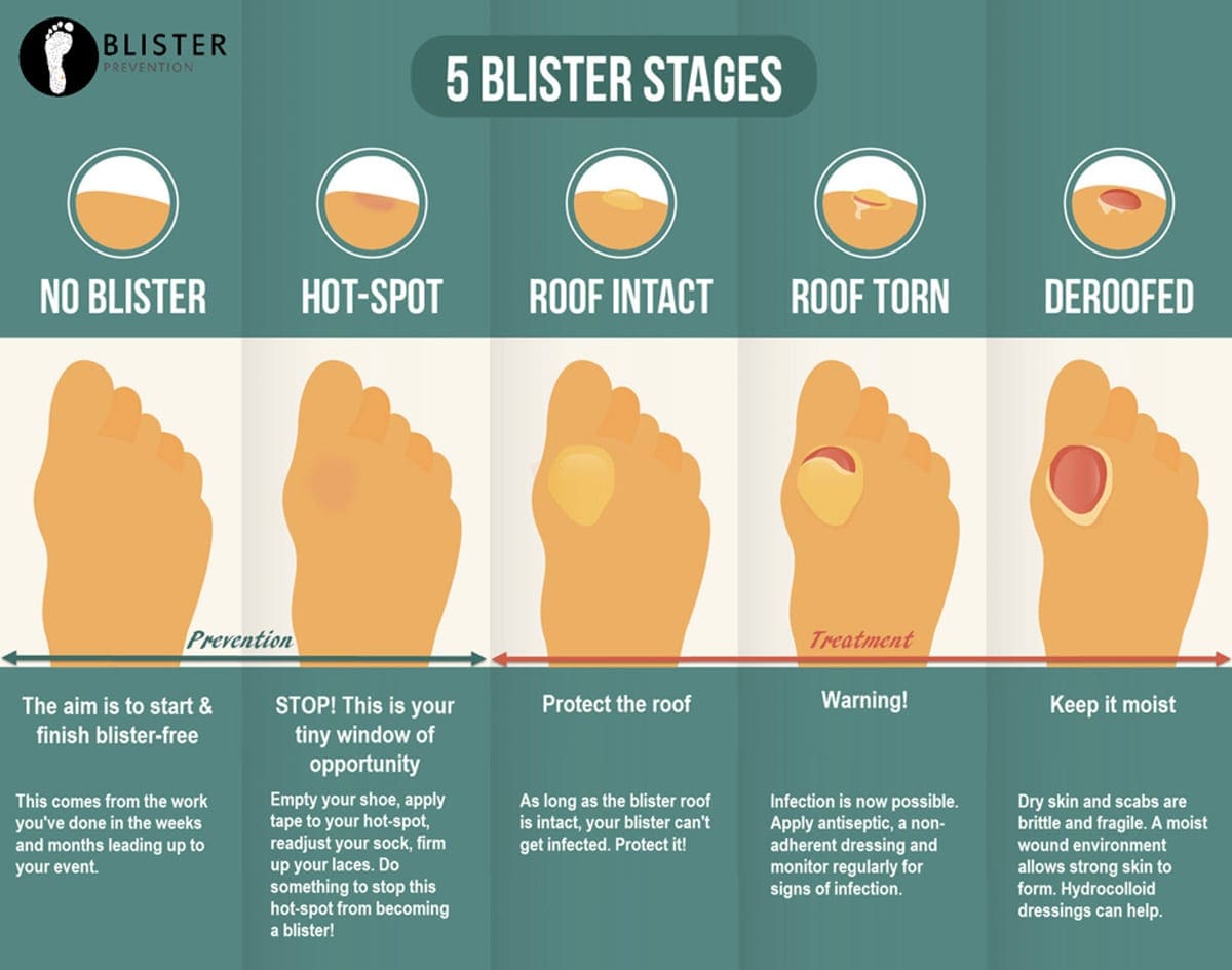 Foot care & blister treatment when hiking Foot care & blister treatment